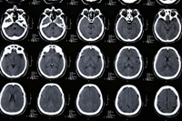 tbi