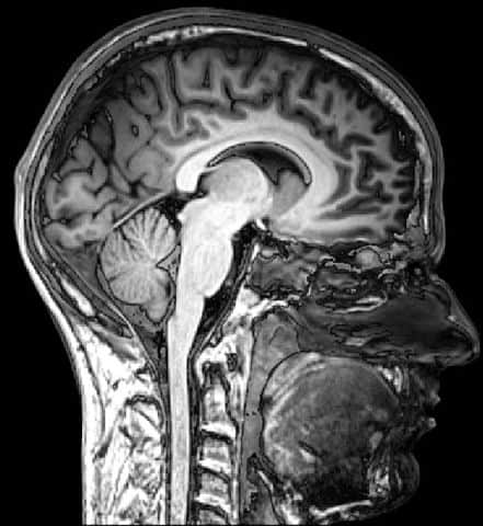 MRI Brain scan