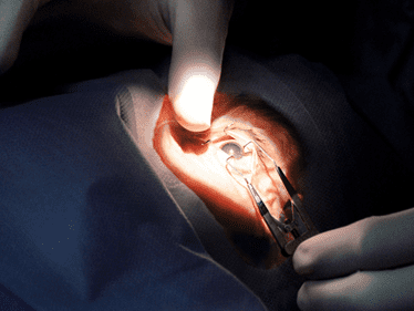 eye procedure